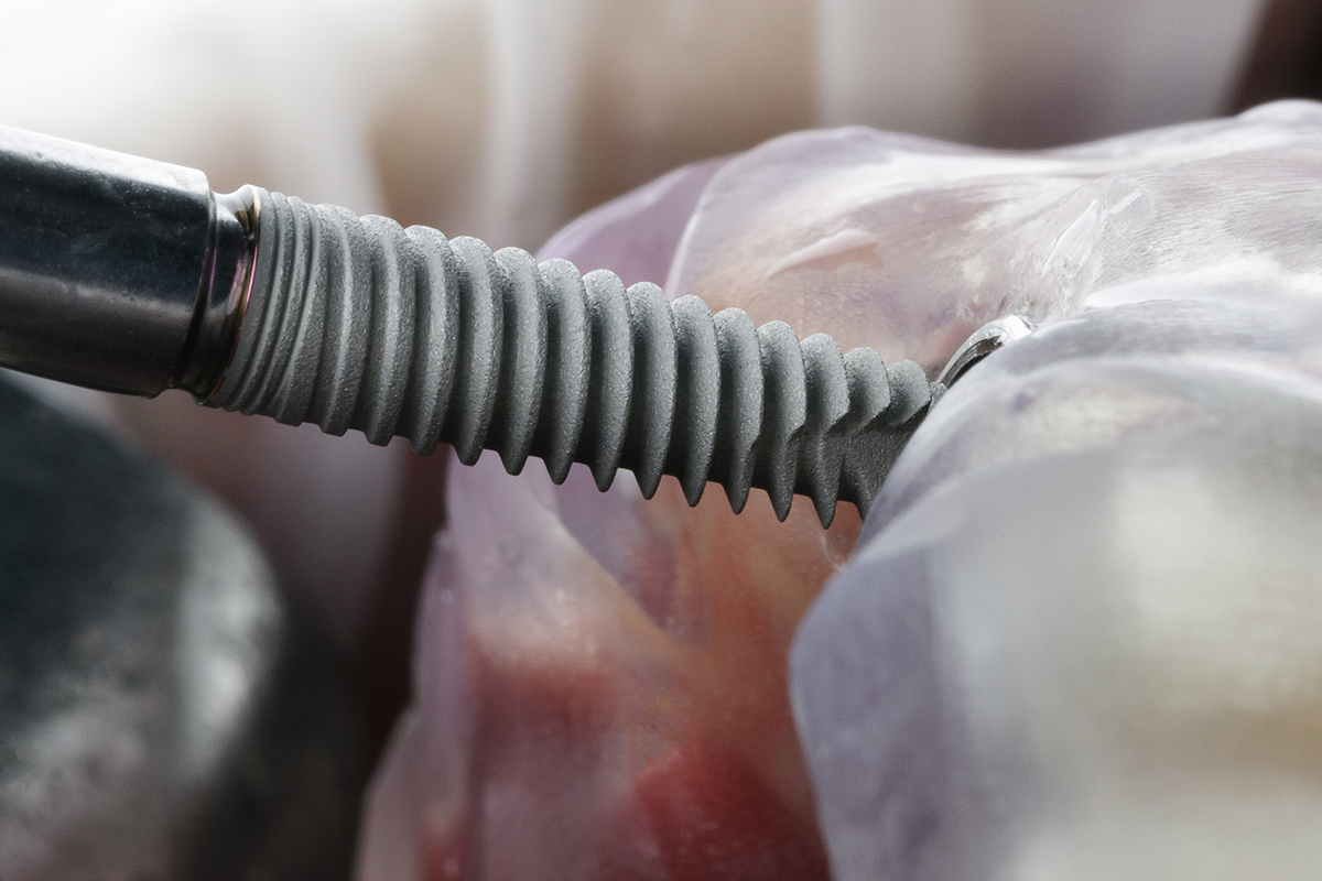 interesting perspective before installing a dental implant through a surgical template